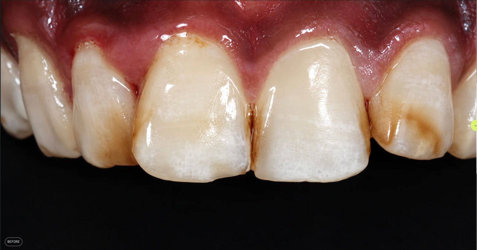 Patient's front teeth before treatment, showing surface staining and discolouration